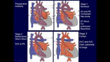 8. Anomalies of the Cardiac Chambers 3 Hypoplastic Left Heart Syndrome _ Critical Aortic Stenosis