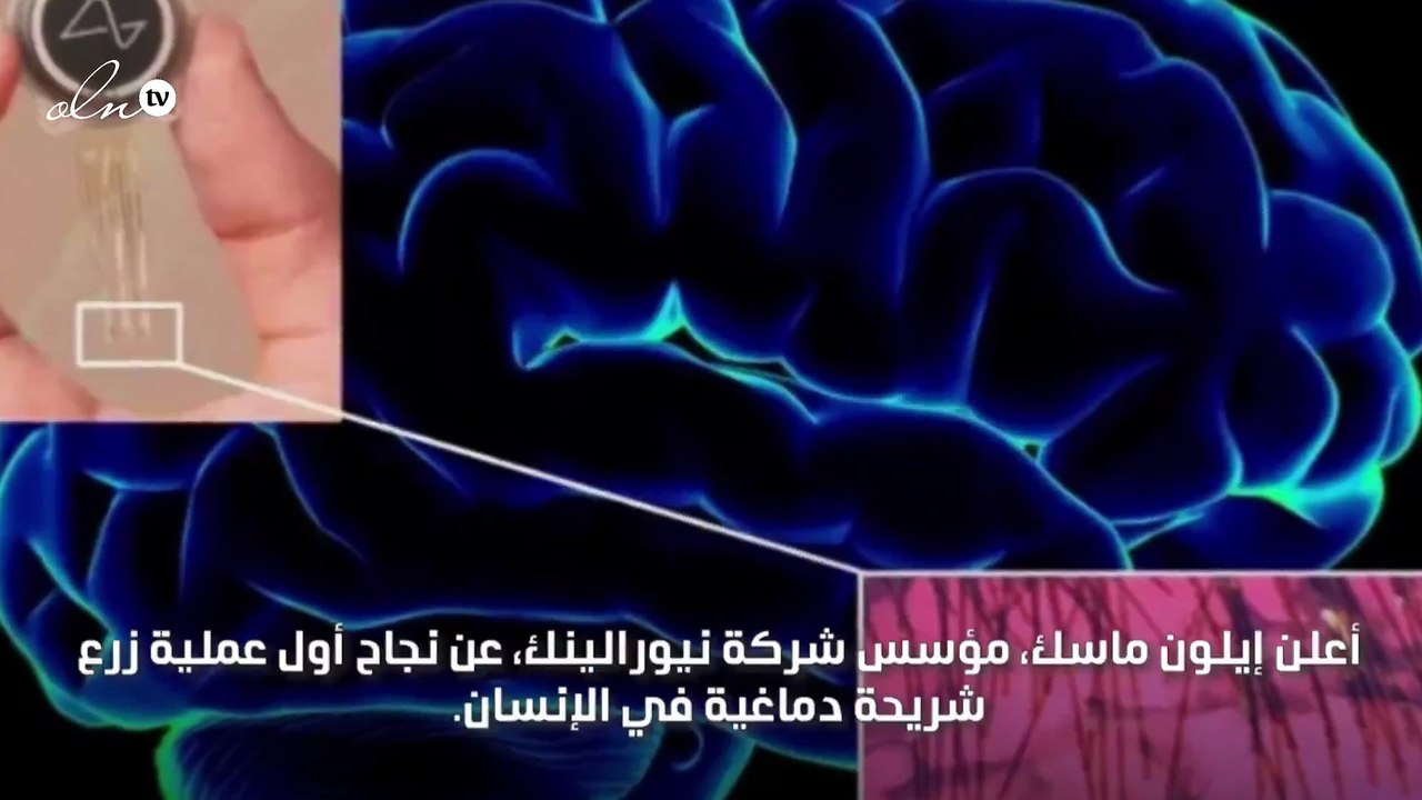 إيلون ماسك يعلن عن نجاح زرع شريحة دماغية في أول إنسان