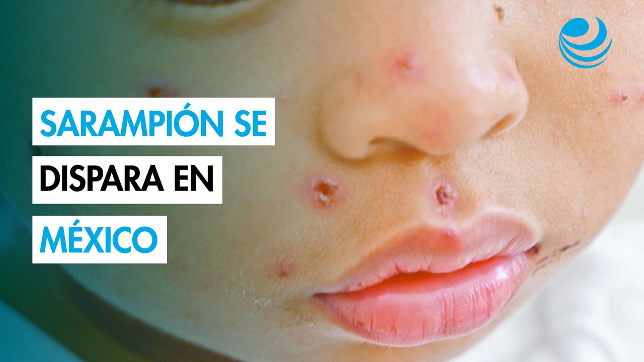 Sarampión: La importancia de la vacunación ante el repunte de contagios