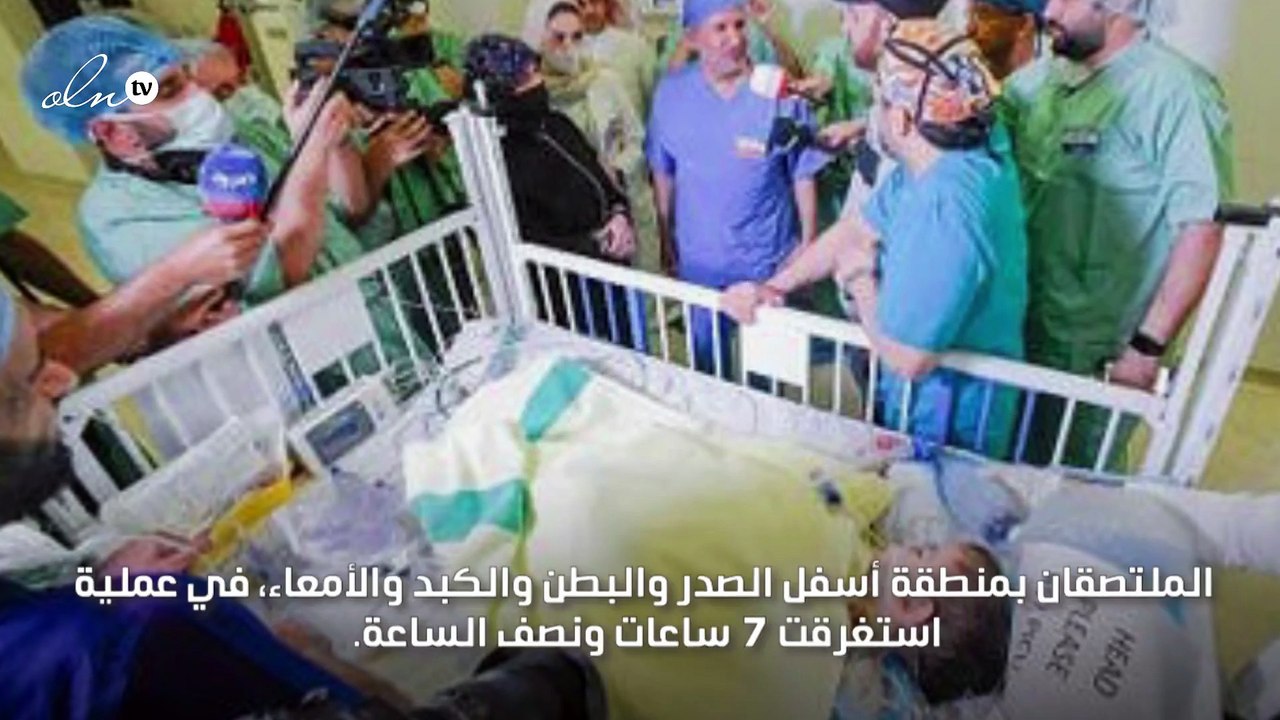 نجاح فصل التوأم السيامي السوري إحسان وبسام بالسعودية