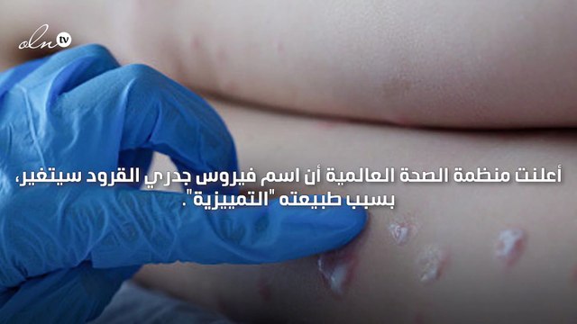 تغيير اسم فيروس جدري القرود إلى hMPXV قريبًا