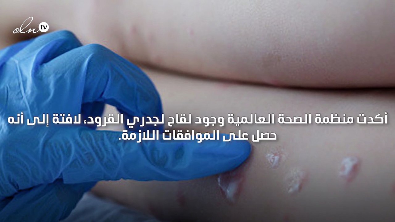 الصحة العالمية تعلن وجود لقاح لـ"جدري القرود"