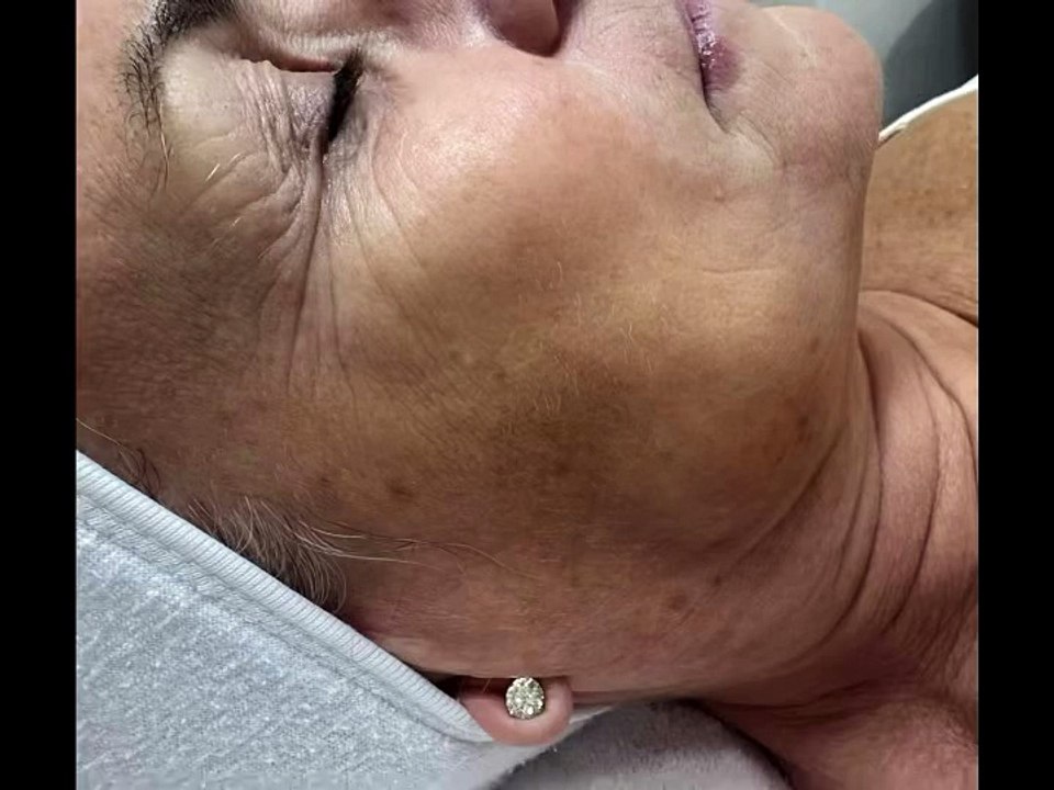 Brightening Fruit Acid Peel in West Kensington London | Skin Brightening Treatment Near You