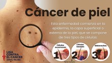 Cáncer de piel