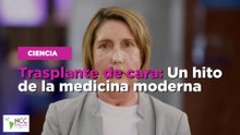 Trasplante de cara: Un hito de la medicina moderna