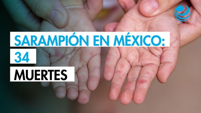 Sarampión en México: Aumentan a 34 las muertes y superan 12,000 los contagios