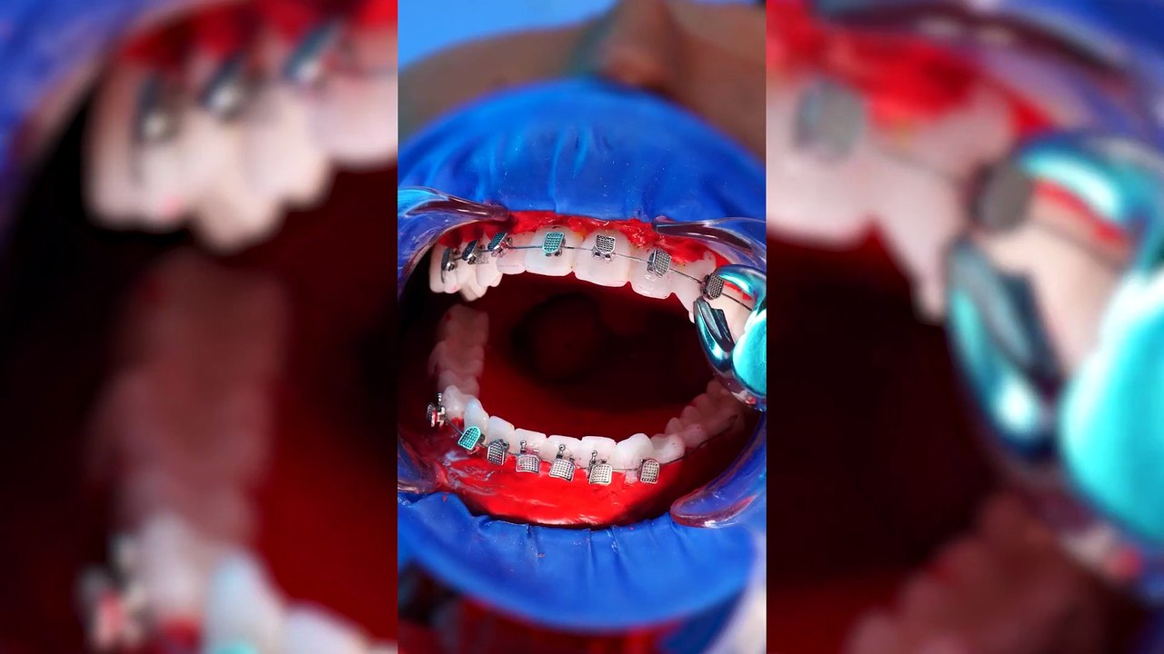 Ultimate Glow-Up: Braces Off & Professional Teeth Cleaning Results 🤍🦷