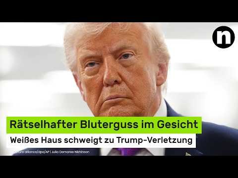 Donald Trump gestürzt?: Rätselhafter Bluterguss im Gesicht - Weißes Haus schweigt zu Verletzung
