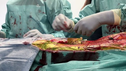 &Agrave; Saint-&Eacute;tienne, la clinique mutualiste modernise sa salle hybride