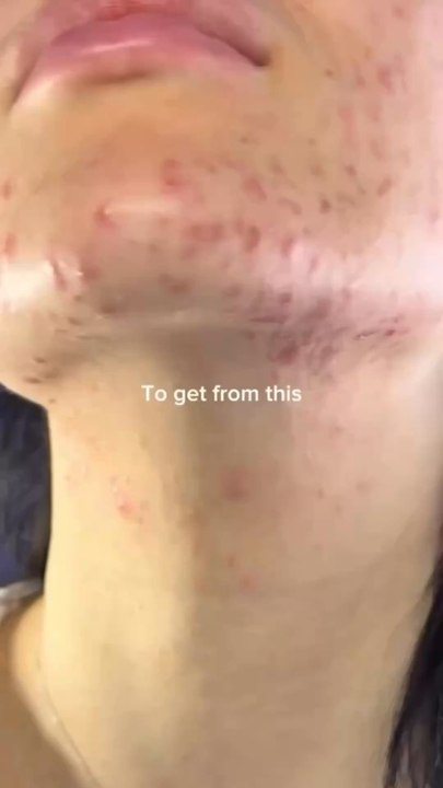 ✨ Dr. Althea 345 CreamAvant : acné & rougeursAprès : peau apaisée, hydratée et teint plus uniforme