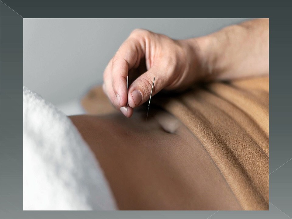 Natural Healing and Recovery With Acupuncture Treatment In Finch