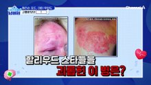 통증의 왕이라 불리는 '대상포진'?! 할리우드 스타들도 피할 수 없었던 극심한 통증