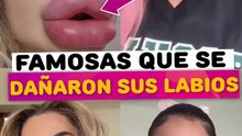 Famosas que se dañaron sus labios