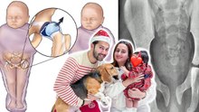 Varun Dhawan Daughter Disease: Hip Developmental Dysplasia क्या है, Reason, Symptoms and Treatment