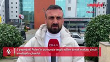 5 yaşındaki Polen, 2 yıldır burnunda tırnak makası zinciriyle yaşamış