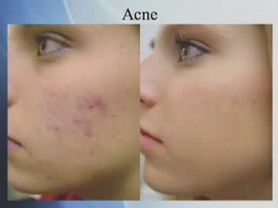 Treat Active Acne