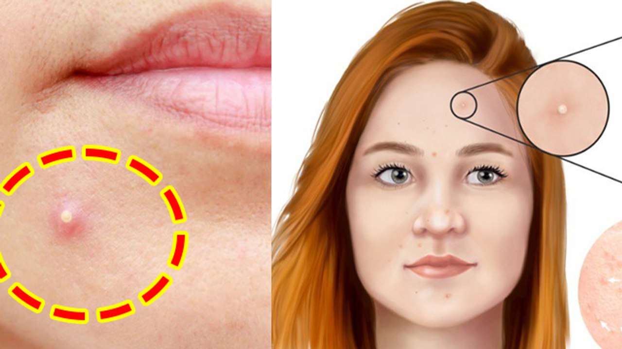 Chehre Par Safed Funsi Ka Ilaj: चेहरे पर सफेद फुंसी का इलाज,क्यों होती है |Boldsky