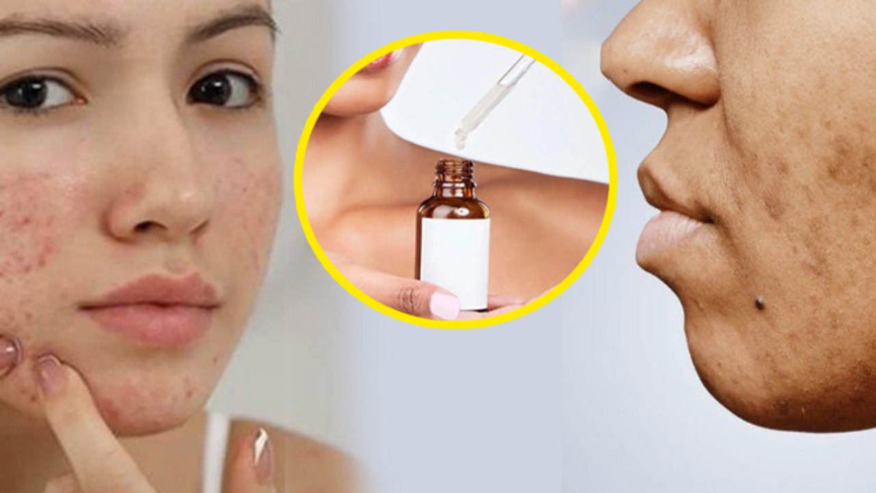 Vitamin C Vs Niacinamide Serum: विटामिन सी या नियासिनमाइड बेहतर क्या | Dark Spots,Oily Or Dull Skin