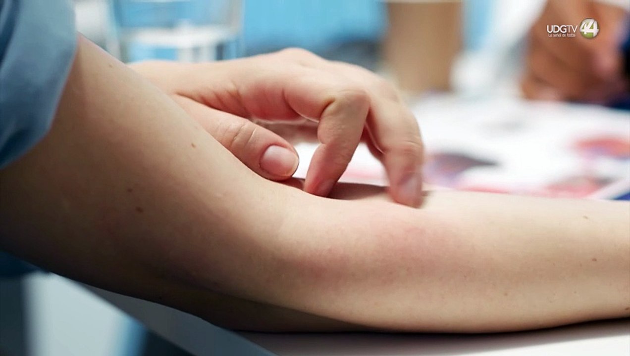 Una muerte más y casi cinco mil casos de sarampión en Jalisco