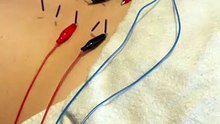 Dry needling vs electrical modalities