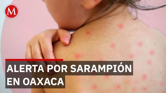 Reportan 32 casos confirmados de sarampión en menores de edad en Oaxaca