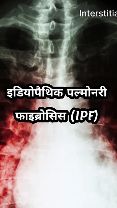 इडियोपैथिक पल्मोनरी फाइब्रोसिस