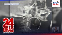 Lalaking may braces, aksidenteng nalunok ang wire; maaalis kaya? | 24 Oras