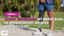 Dolor fantasma: el dolor tras la amputación de una extremidad