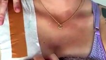 Tapping for shoulder dislocation