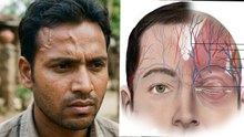 Mathe Ki Nas Fadakna: माथे की नस दिखना,फड़कना,कारण और इलाज | Forehead Nerve Visible