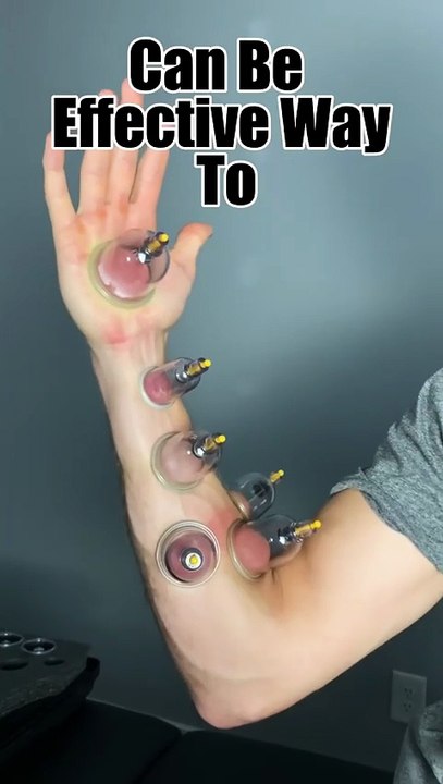 Cupping therapy