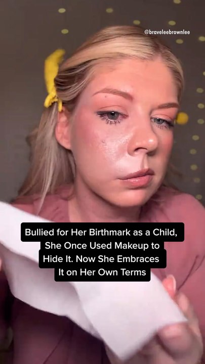 Bullied for Her Birthmark as a Child, She Once Used Makeup to Hide It. Now She Embraces It on Her Own Terms