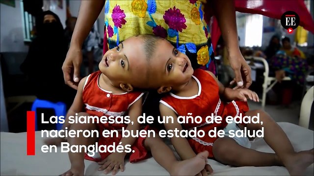 Cirugía para separar gemelas unidas por el cráneo en Bangladés | El Espectador