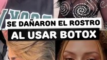 Famosas que se dañaron el rostro por ponerse mucho bótox