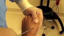 Remove screw after surgery