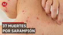 México enfrenta una crisis epidemiológica por sarampión en diversas entidades