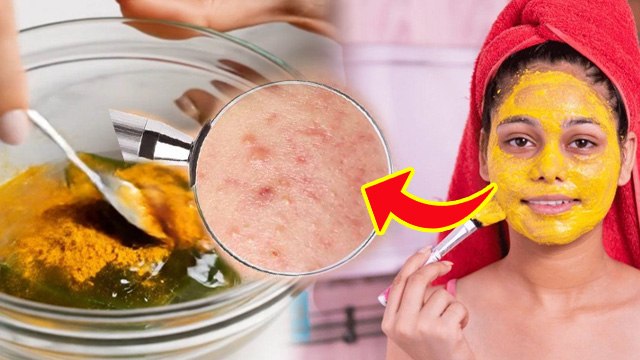 Chehre Par Gadde Mitane Ke Liye Cream: चेहरे पर गड्ढे कैसे दूर करें,घरेलू उपाय |Acne Scars Treatment