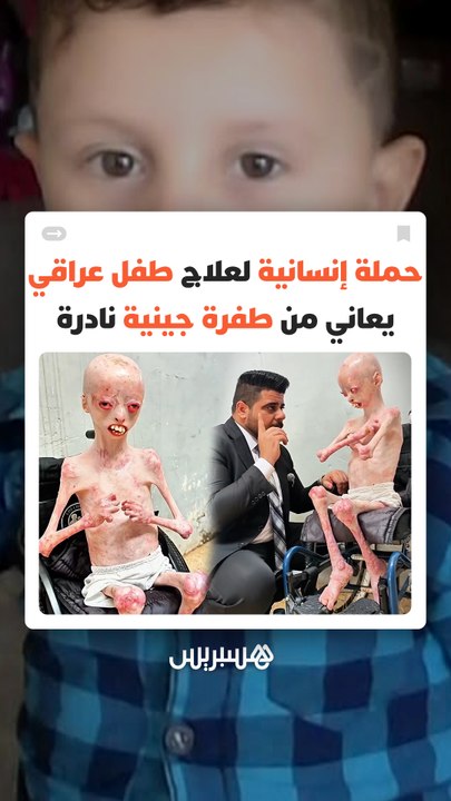 جعلت جسده بلا جلد يحميه.. حملة إنسانية لعلاج طفل عراقي يعاني من طفرة جينية نادرة