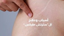 أسباب وعلاج السترتش ماركس