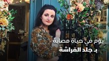 يوم في حياة مصابة بـ جلد الفراشة