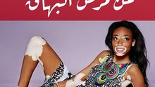 5 خرافات و5 حقائق عن مرض البهاق