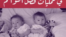 السعودية.. الأولى عالمياً في عمليات فصل التوائم
