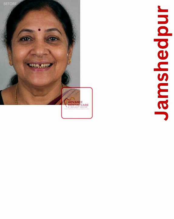Best Dental Clinic in Jamshedpur | Smile Transformation Before & After | Advance Dental Care 🦷✨