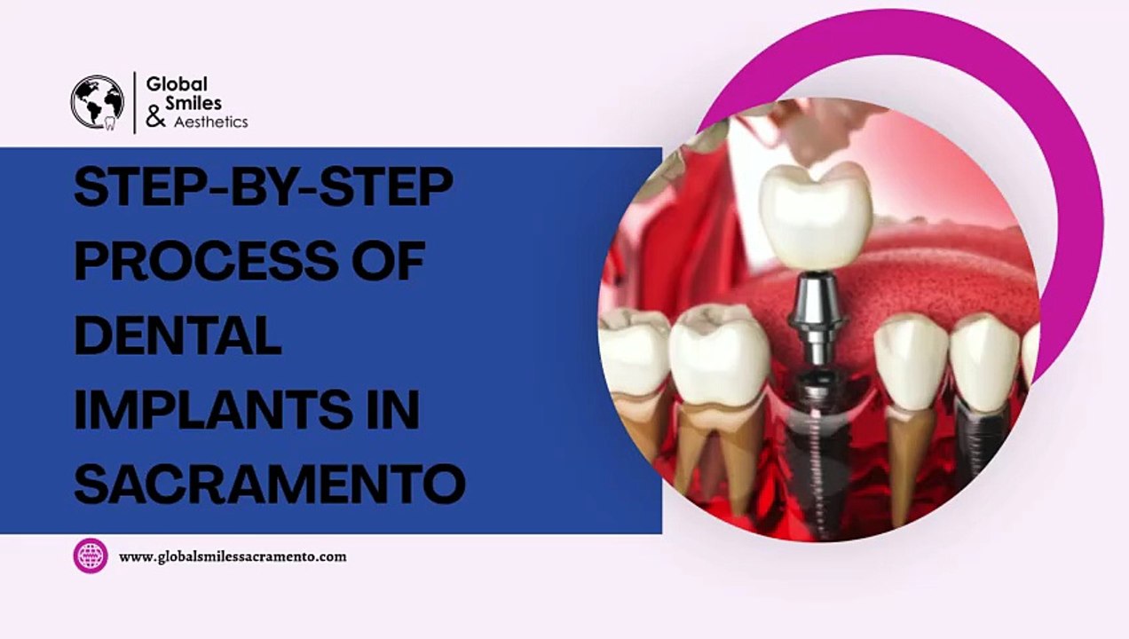 Step-by-Step Process of Dental Implants in Sacramento