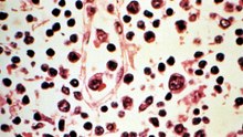 What is hantavirus, the deadly disease aboard a cruise ship?