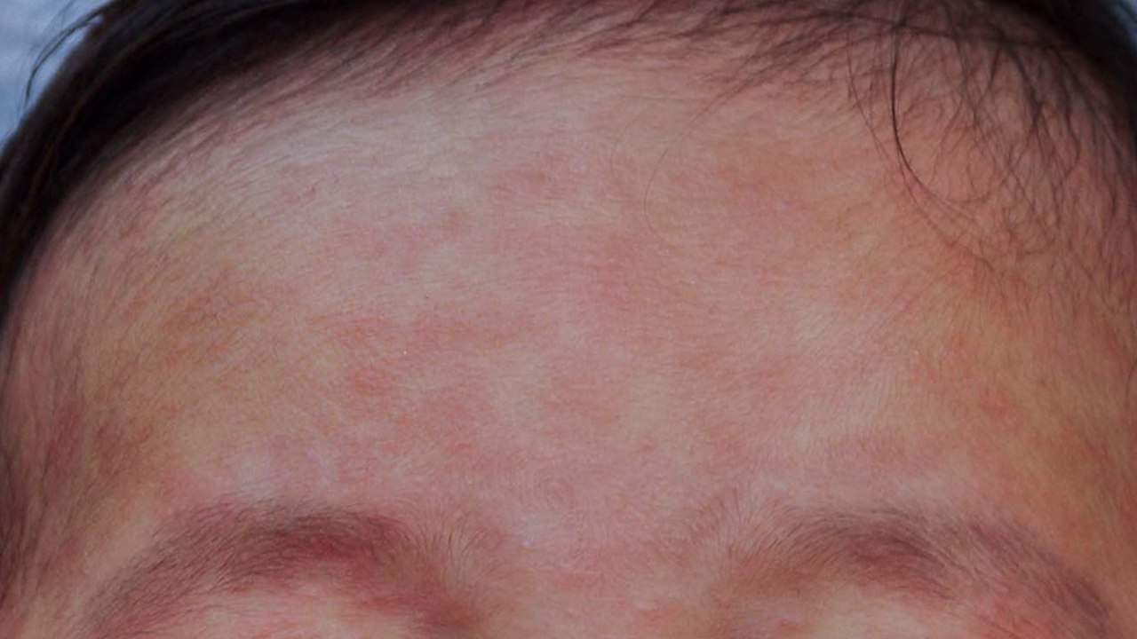 Measles cases spread in West Midlands as vaccin...