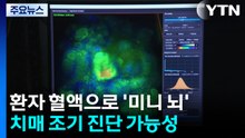 혈액으로 만든 '미니 뇌'로 알츠하이머 조기 진단 / YTN