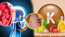 Vitamin K Deficiency Disease:विटामिन K की कमी से कौन सी बीमारी होती है,Symptoms,कमी कैसे पूरी करें..