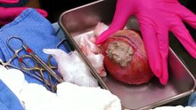Dr Pimple Popper Breaking Out S02E02 Gone in CYST Y Seconds H 264