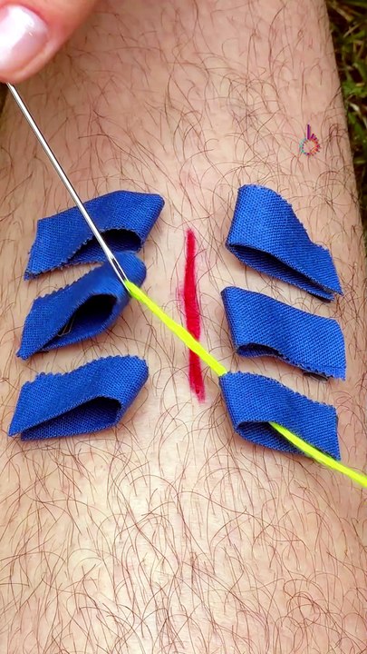 Emergency wound patching method